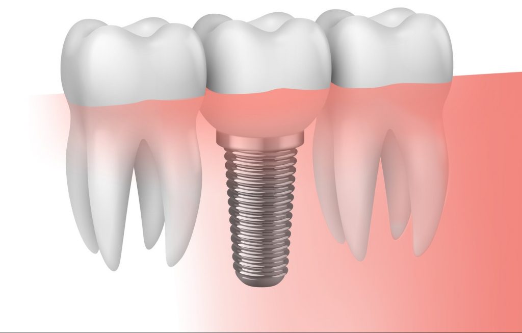 cuidado de un implante dental