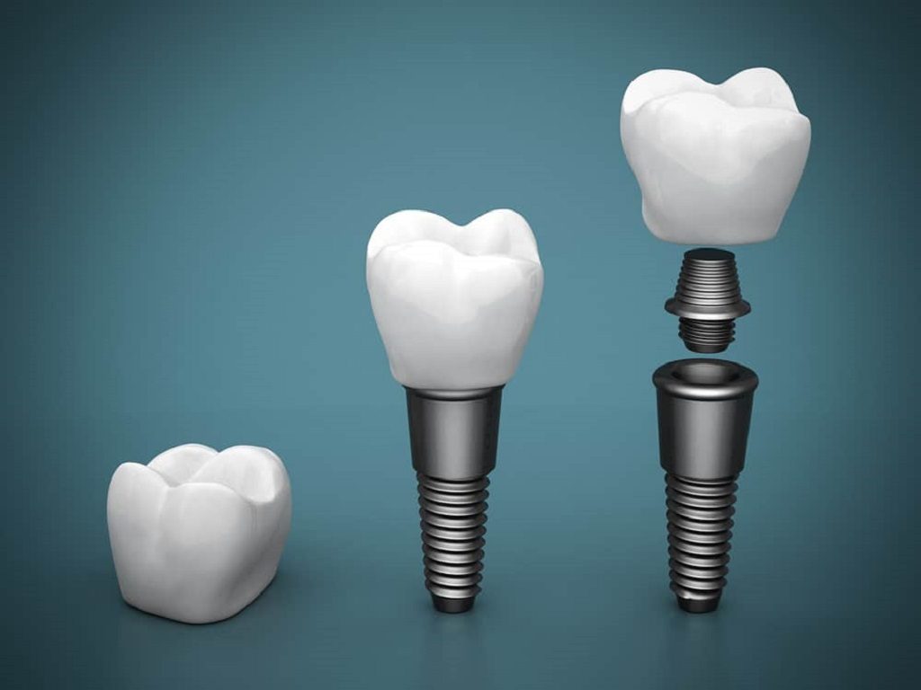 partes del implante dental
