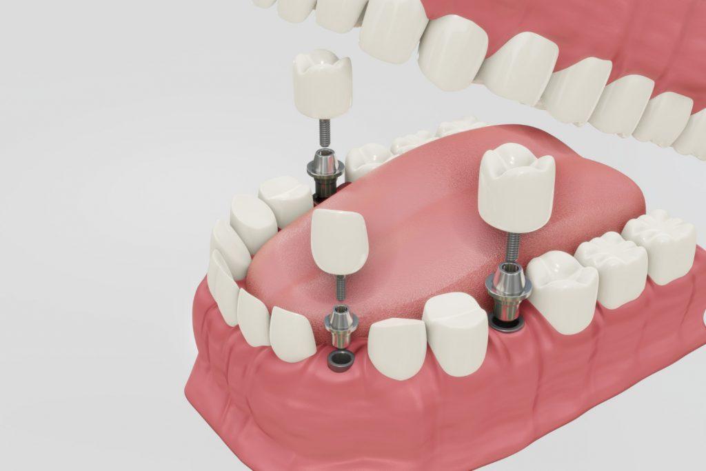 Los cuidados perfectos tras someterse a implantes dentales