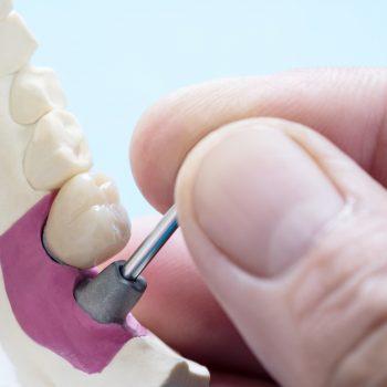 Beneficios de los implantes dentales