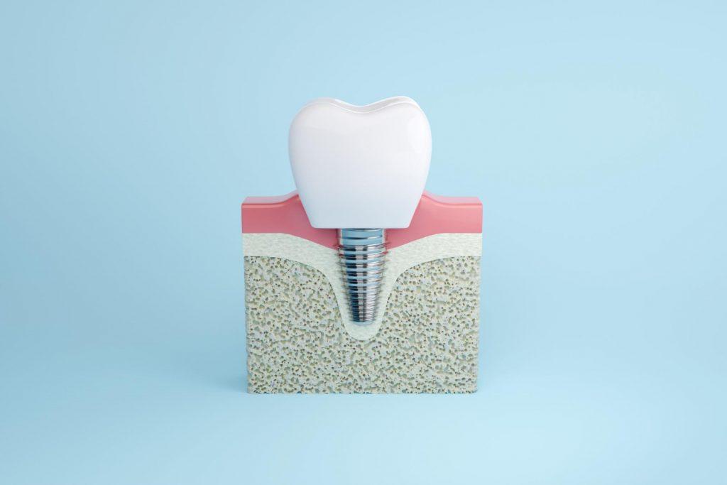 nuevas tecnologías y avances en implantes dentales