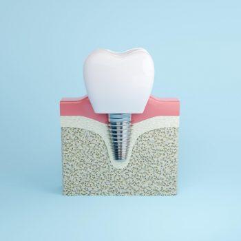 nuevas tecnologías y avances en implantes dentales