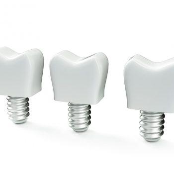 implantes
