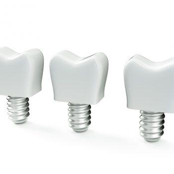 dañar unos implantes dentales