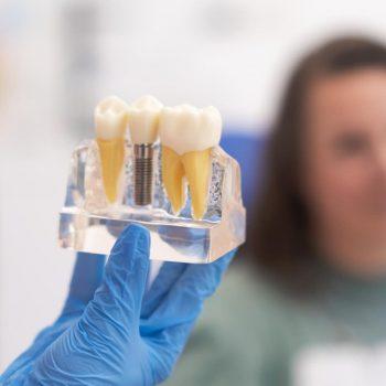 leyendas urbanas sobre implantes dentales