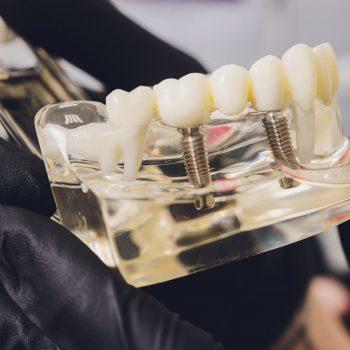 qué soluciones hay ante la pérdida dental