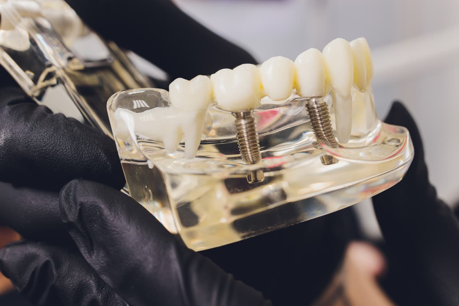 qué soluciones hay ante la pérdida dental