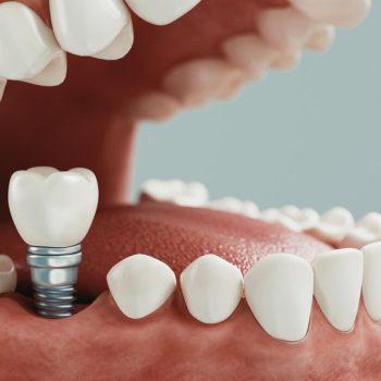 implantes dentales
