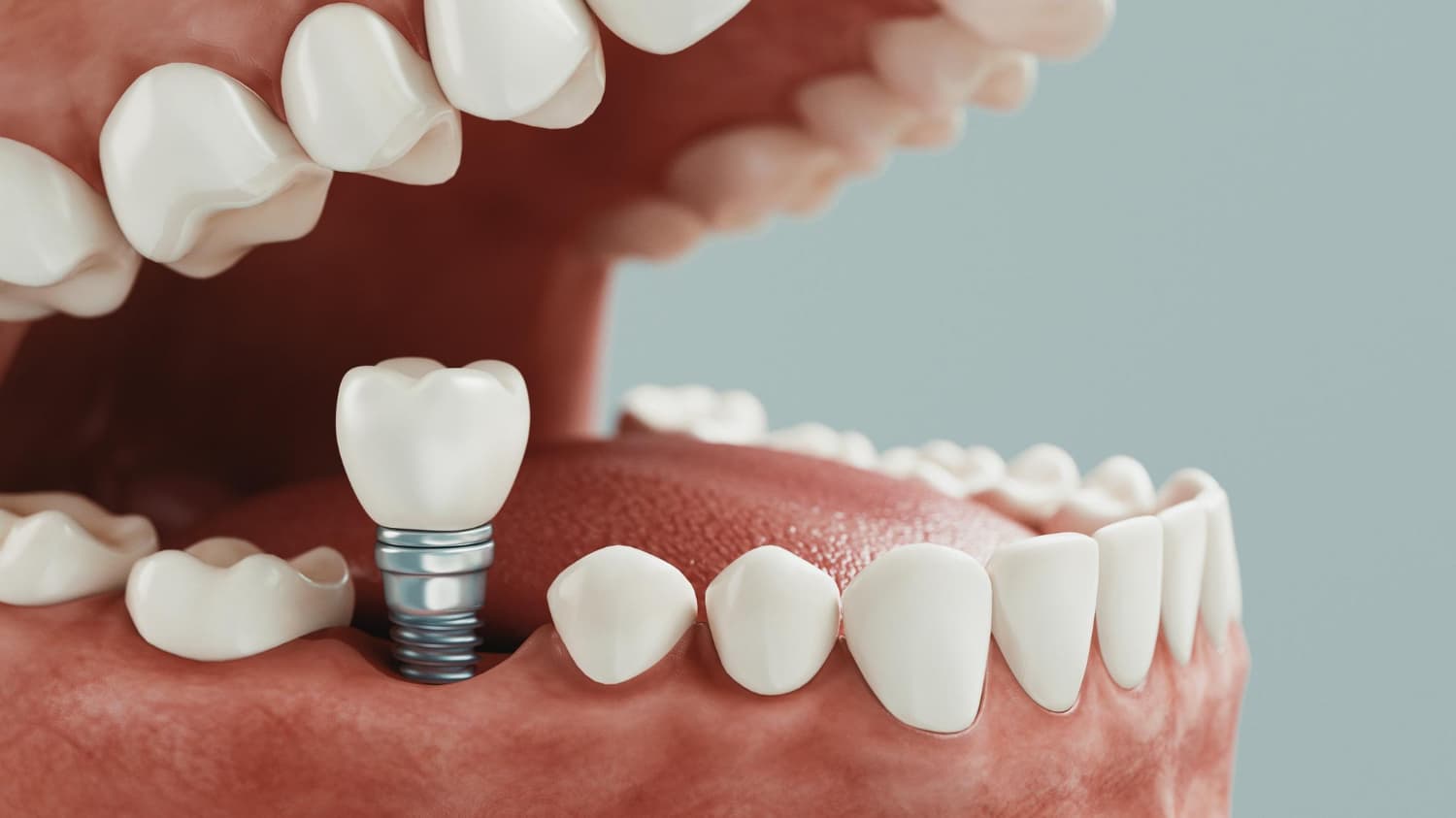 implantes dentales
