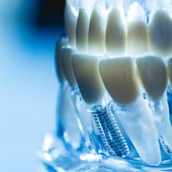 implantes dentales