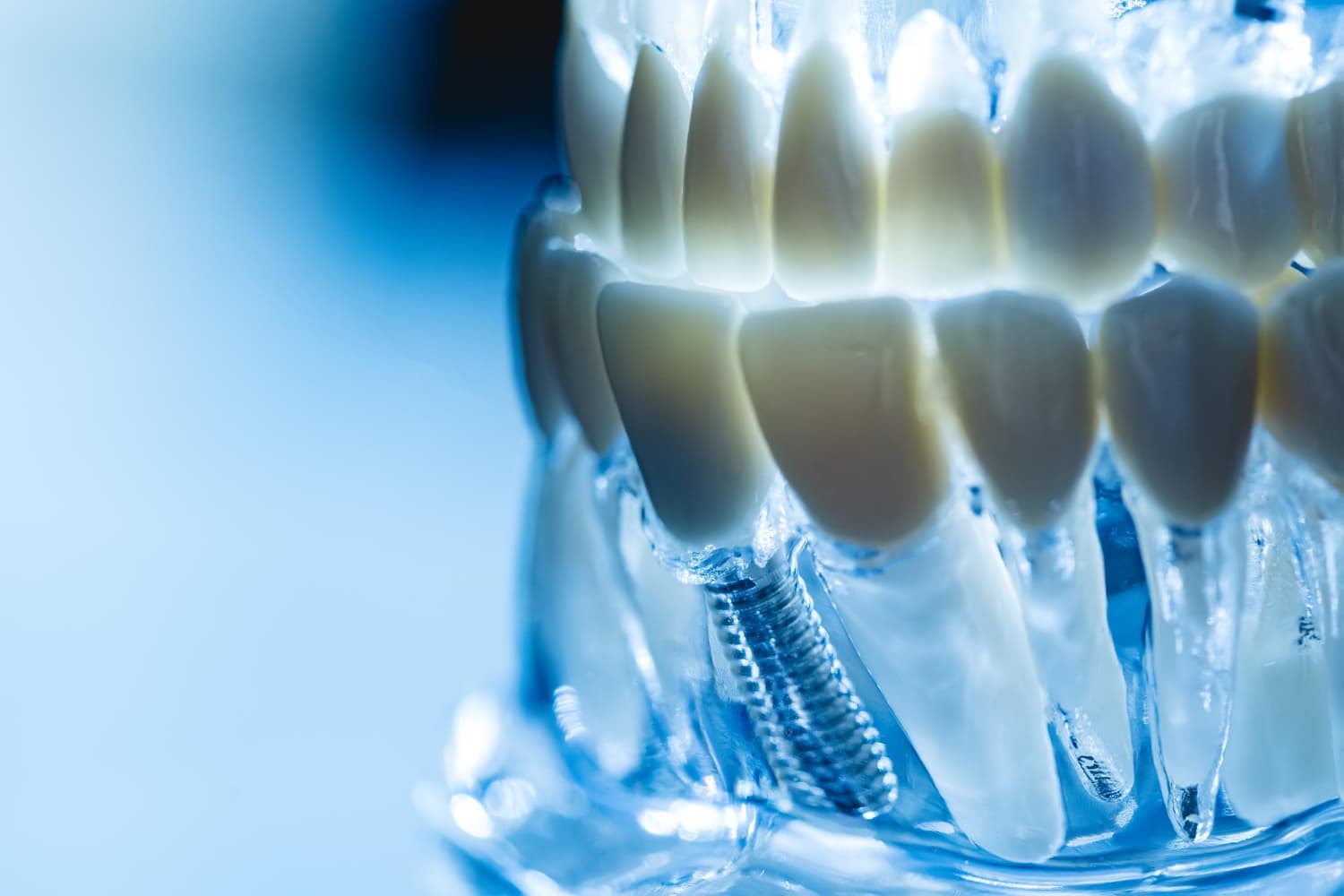 implantes dentales