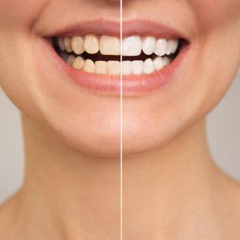 blanqueamiento dental instantáneo