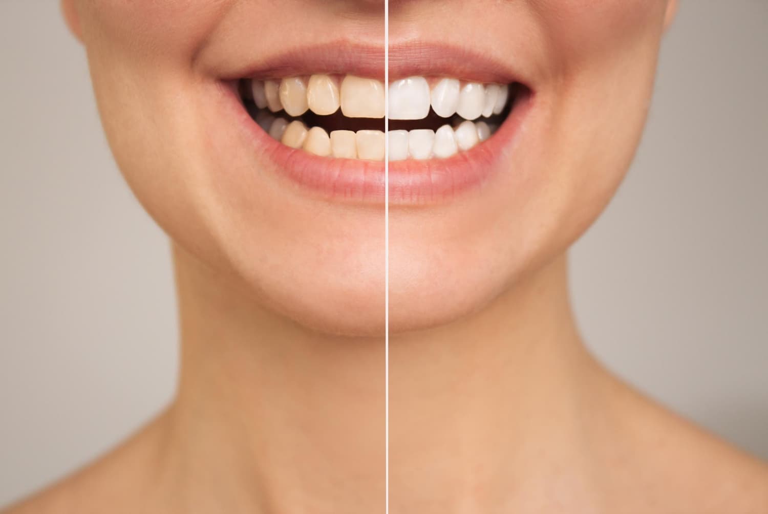 blanqueamiento dental instantáneo