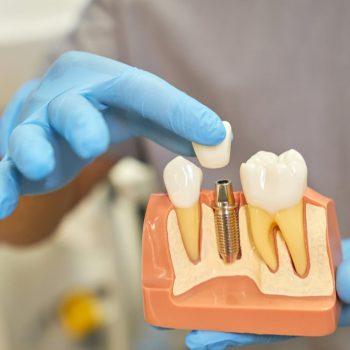 implantes dentales en la tercera edad (1)