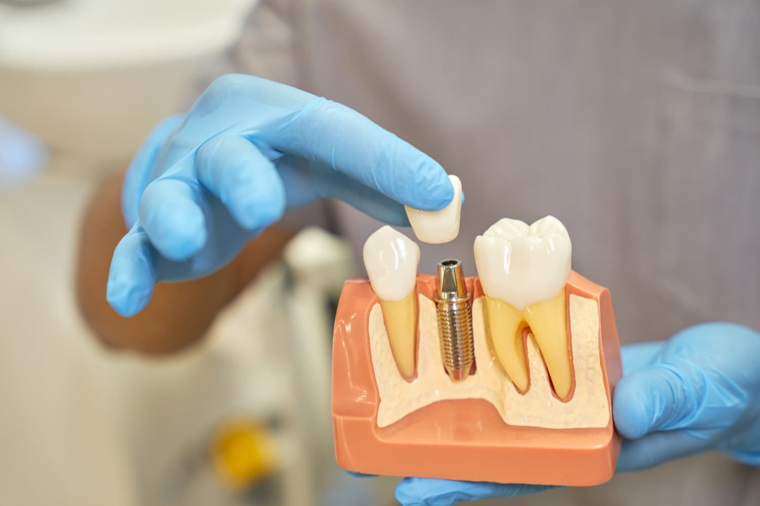 implantes dentales en la tercera edad (1)