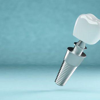 reparación de implantes dentales