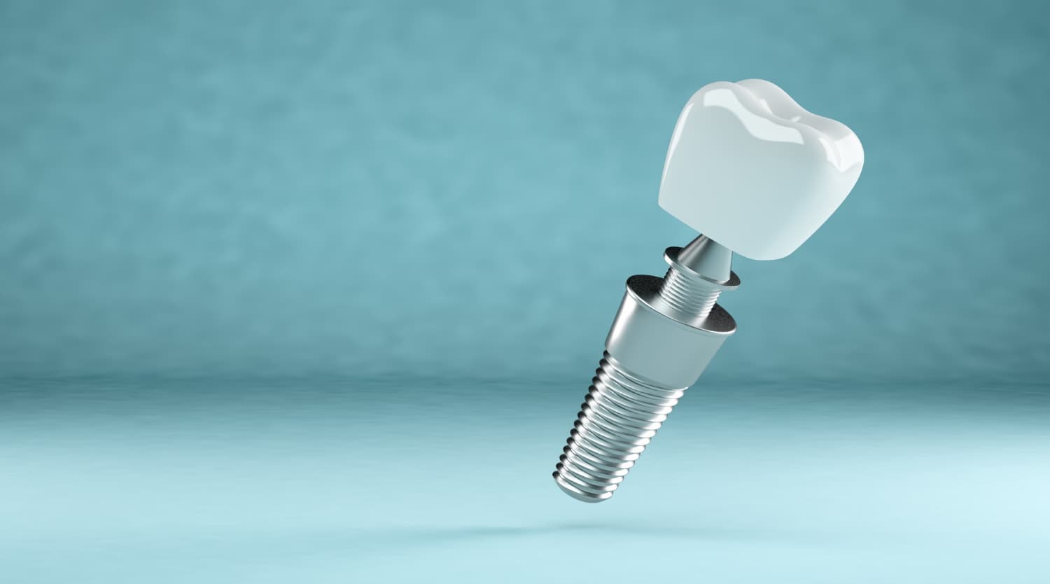 reparación de implantes dentales